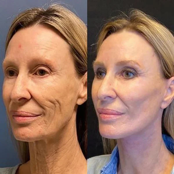Botox näoseerum