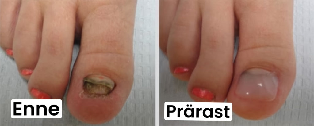 Seenevastane küünte geel