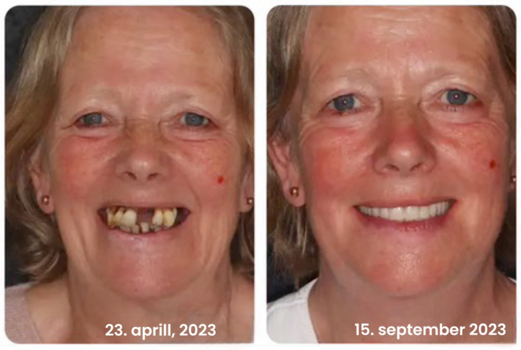 "Smile" hammaste valgendamisvedelik