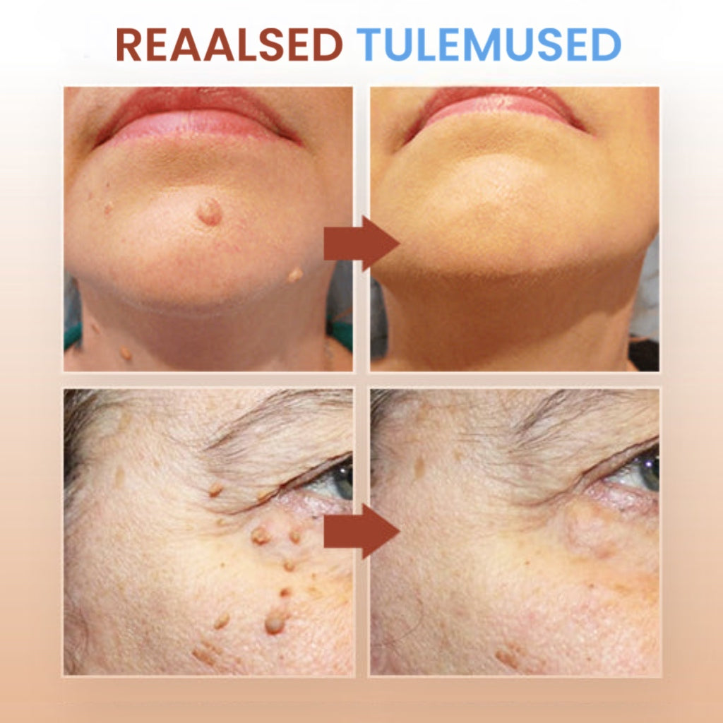 „WartsOff“ tüügaste ja nahamärkide eemaldamise salv