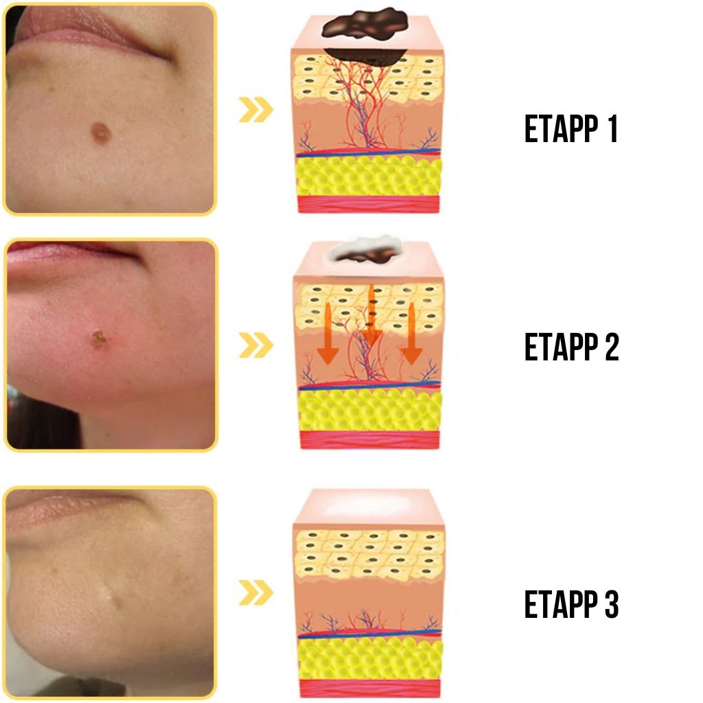Mesilasmürk tervendav sprei