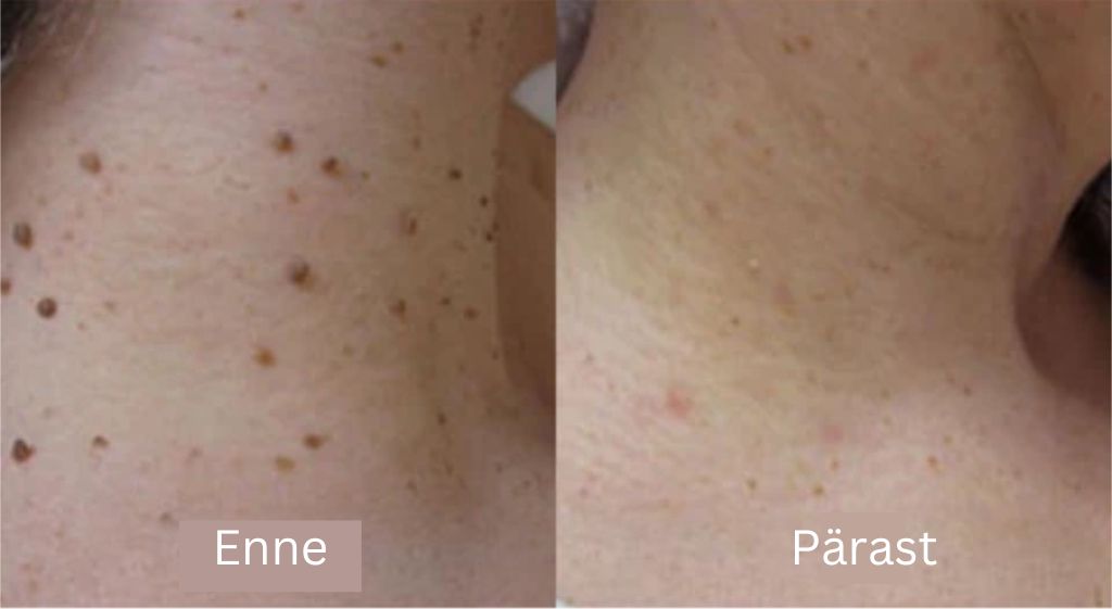 Mesilasmürk tervendav sprei