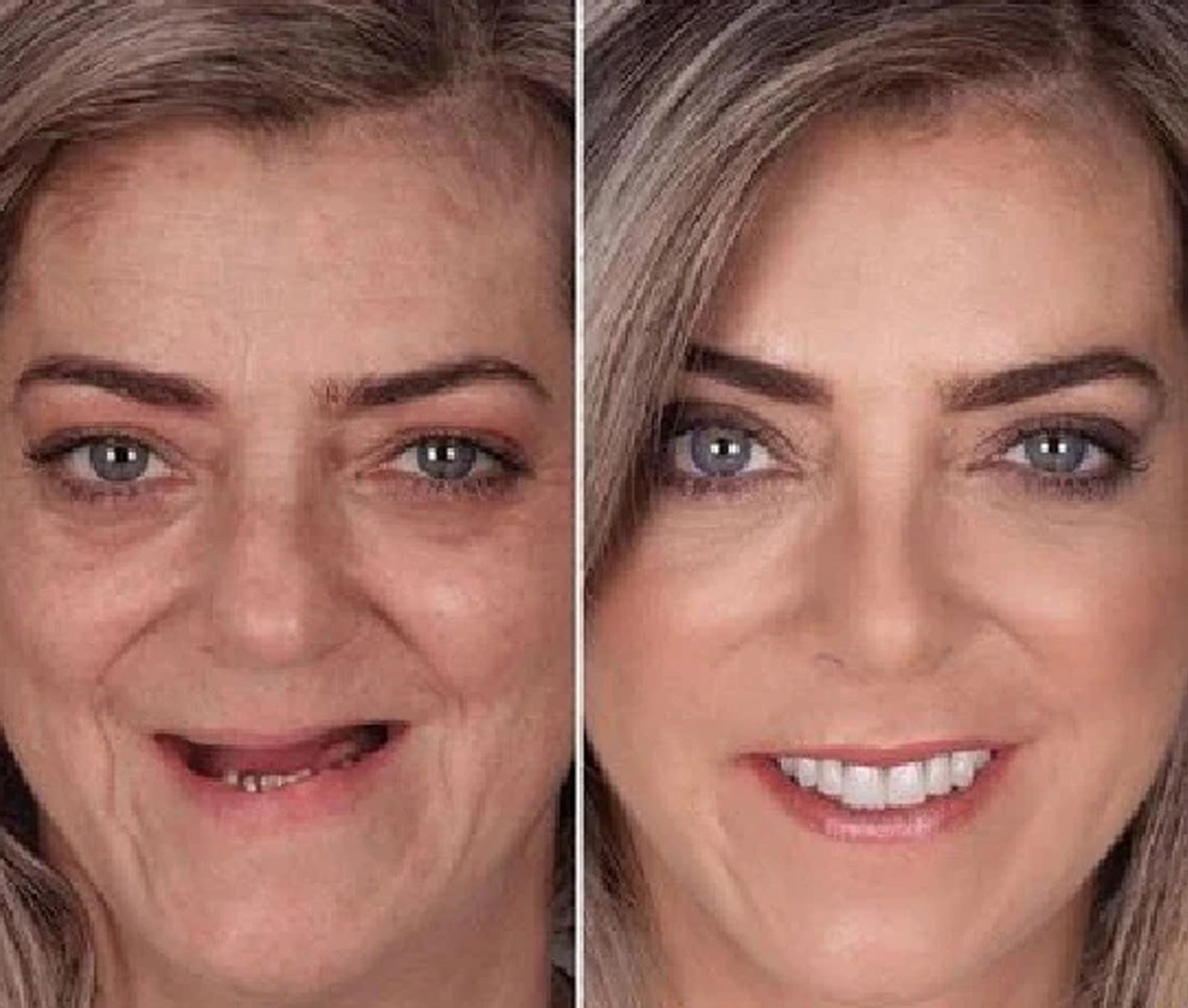 Silikoonist proteesid