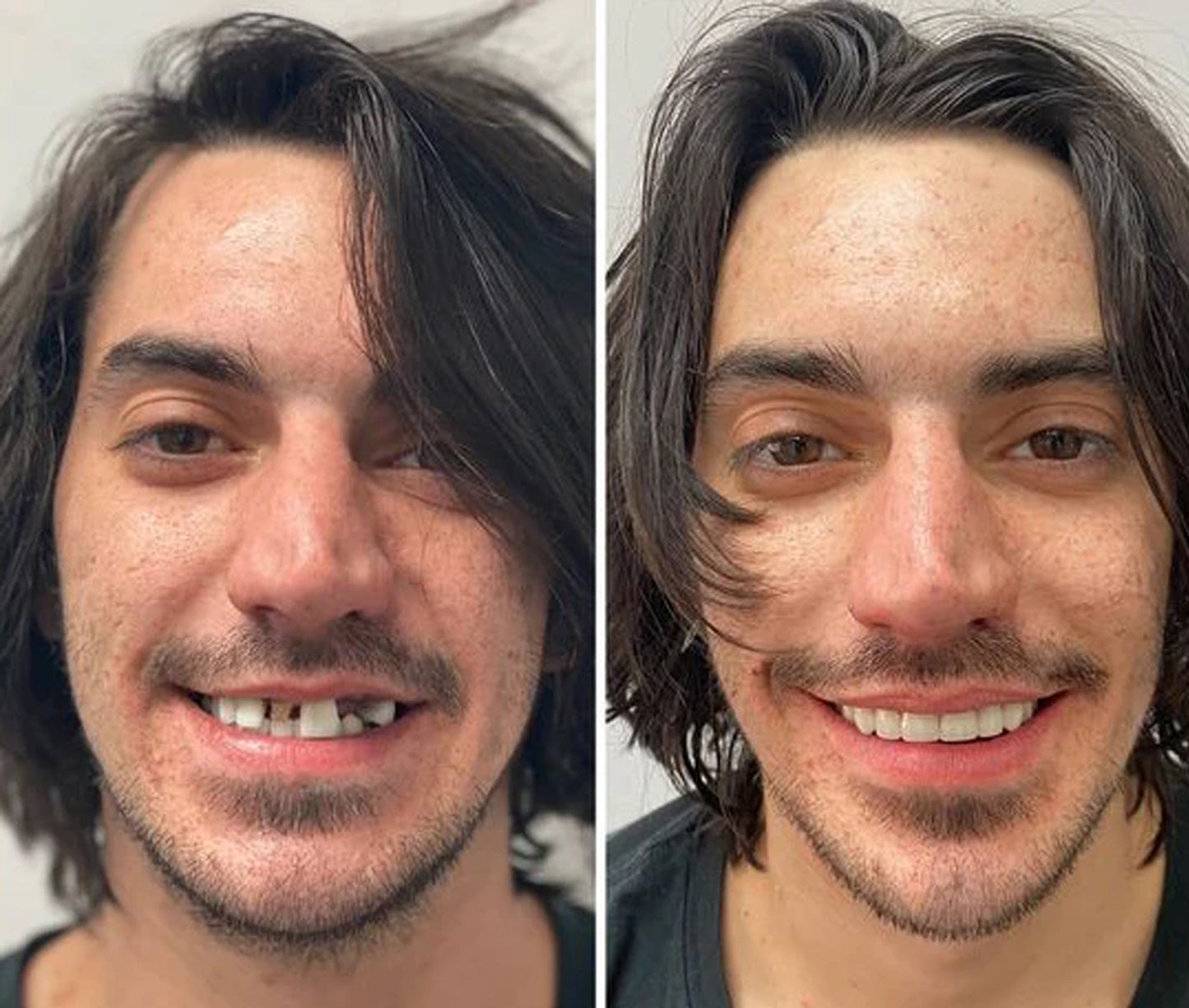 Silikoonist proteesid