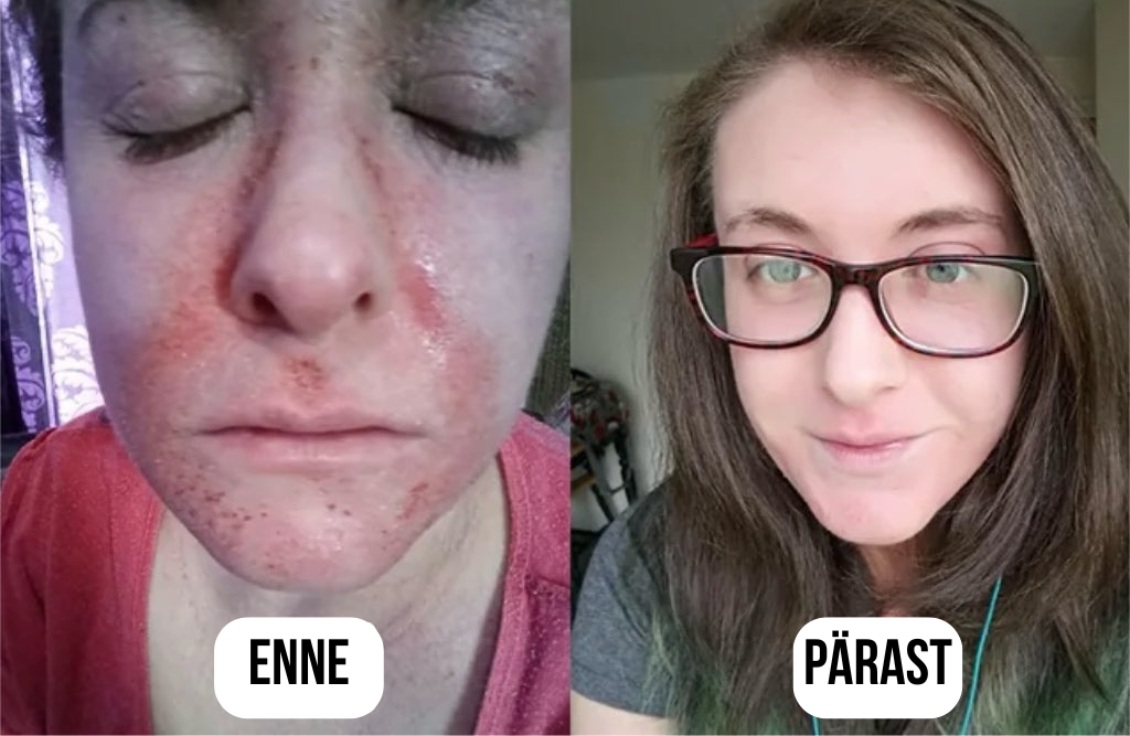 Lehmapiima seerum kõikidele nahaprobleemidele